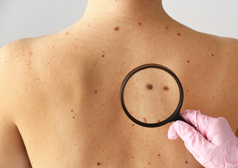 RELACIÓN VITAMINA D Y MELANOMA: ¿AMIGOS o ENEMIGOS?